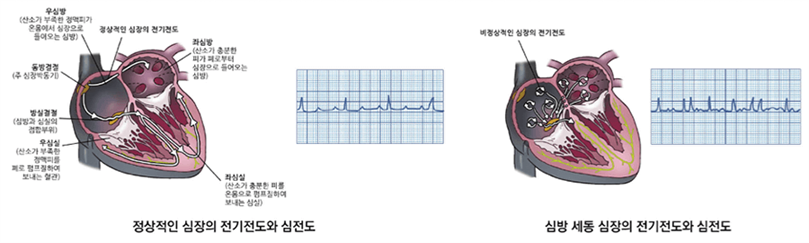 정상적인 심장의 전기전도와 심전도. 심방 세동 심장의 전기전도와 심전도